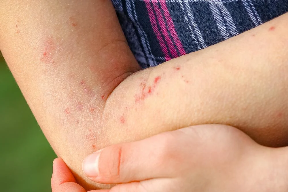 Dermatitis Kontak Alergi: Gejala, Penyebab, dan Pengobatan