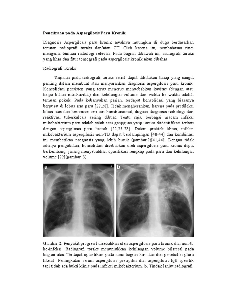 Pencitraan Radiologi Aspergilosis Paru | PDF